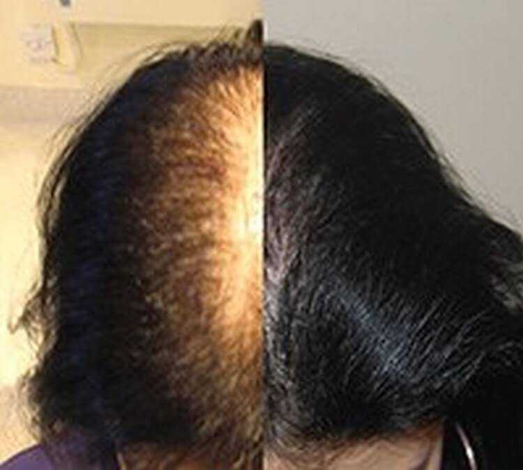Кормящих выпадают волосы. Андрогенетическая алопеция. Андрогенная алопеция алопеция. Финастерид при алопеции у женщин.