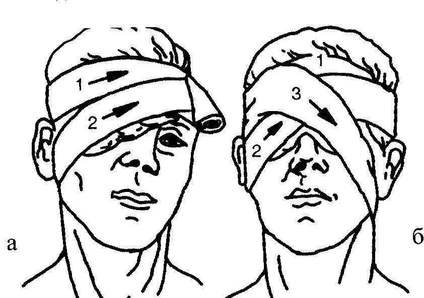 Алгоритм операции наложения. Наложение бинокулярной повязки на оба глаза. Десмургия монокулярная повязка. Моно и бинокулярная повязка. Повязка на 1 глаз десмургия.
