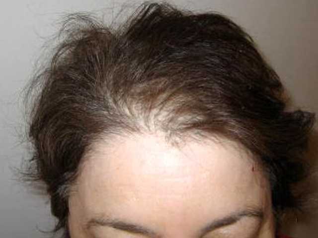 Выпадение волос от йодидов
