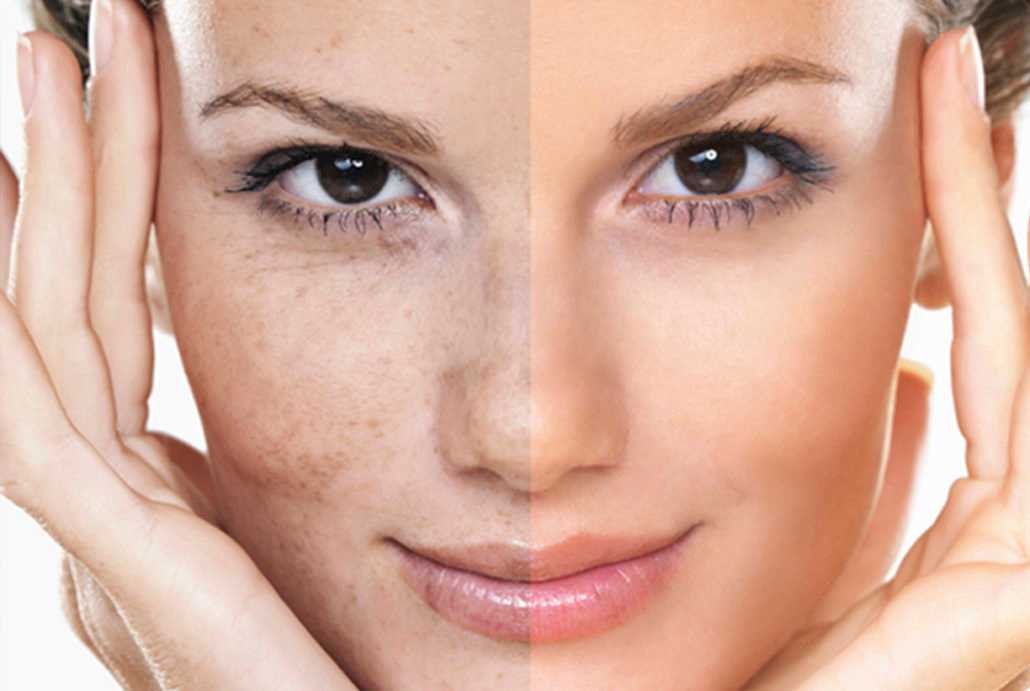 Воздействие солнца на кожу: пятна, покраснения и аллергия